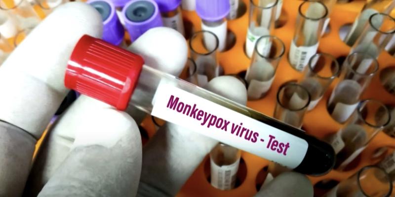 Everything you need to know about monkeypox